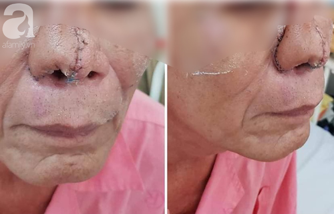 Kinh hoàng cháu nhậu say cắn mũi bác rồi nuốt luôn vào bụng-2