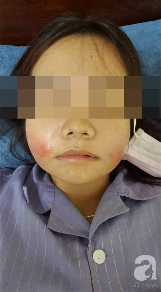 Nhiều người gặp biến chứng do tiêm filler trẻ hóa khuôn mặt, chuyên gia đưa ra khuyến cáo cực quan trọng mà ai cũng cần biết-1