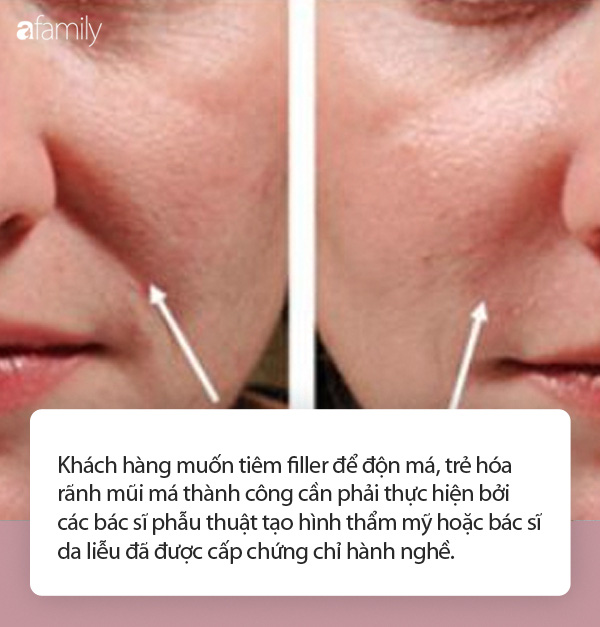 Nhiều người gặp biến chứng do tiêm filler trẻ hóa khuôn mặt, chuyên gia đưa ra khuyến cáo cực quan trọng mà ai cũng cần biết-2