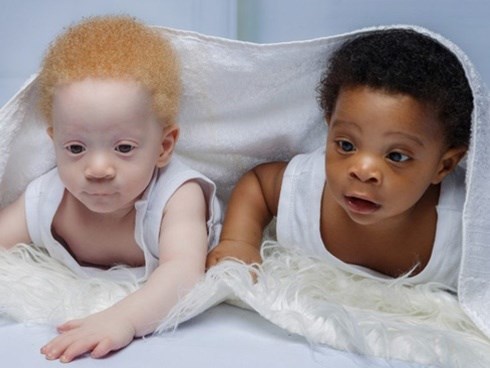 Cặp sinh đôi chào đời cách nhau vài phút nhưng khiến bác sĩ cũng sốc, cả bệnh viện kéo đến chụp ảnh