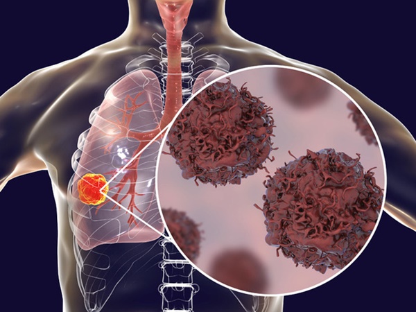 Tế bào ung thư phổi thích nhất khi gặp 4 kiểu người mà ai cũng dễ thấy trong cuộc sống-4