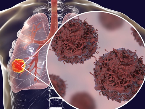 Đừng coi thường khi đau lưng, bởi có thể là dấu hiệu của ung thư phổi-5