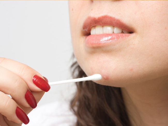 Bạn hay bị mụn ở vị trí nào? Bác sĩ sẽ chỉ ra nguyên nhân và cách chữa trị chuẩn nhất-5