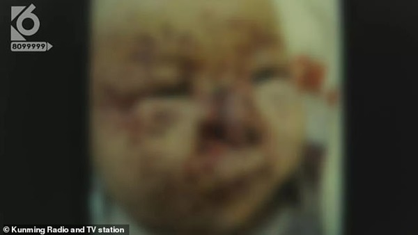 Bố mẹ đi vắng 15 phút, bé gái 3 tháng tuổi bị 100 vết thương trên mặt vì lý do khiến ai cũng hãi hùng-2