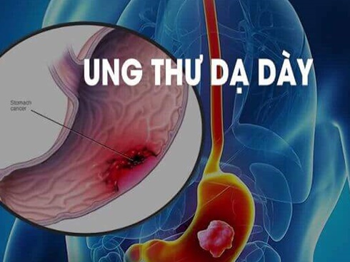 Cậu bé 6 tuổi đã bị ung thư dạ dày, nhắc nhở sau khi ăn xuất hiện 3 điểm bất thường cần phải đi khám-5