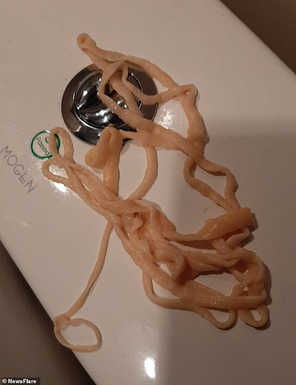 Kinh hãi những ca lấy được sán dài cả mét từ trong cơ thể, làm thế nào để phòng tránh sán dây làm tổ?-3