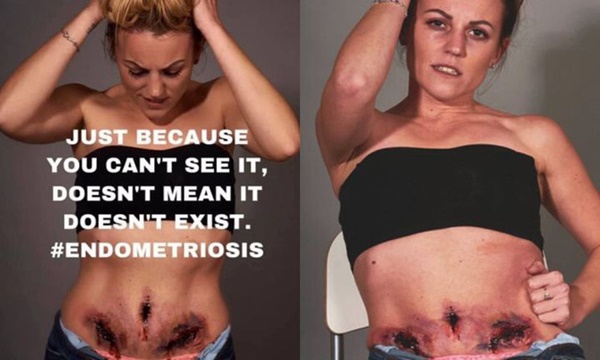 Nghe nói nhiều về bệnh lạc nội mạc tử cung rồi nhưng bạn có thực sự biết nỗi đau chỉ trời mới thấu này?-1