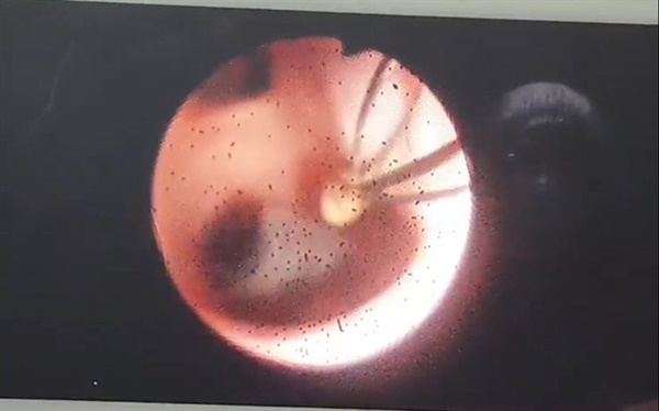 Kinh hãi hàng nghìn con sán lá gan làm tổ nhung nhúc trong đường mật người đàn ông: Chấm dứt thói quen ăn uống này ngay nếu bạn không muốn bị bệnh!-1