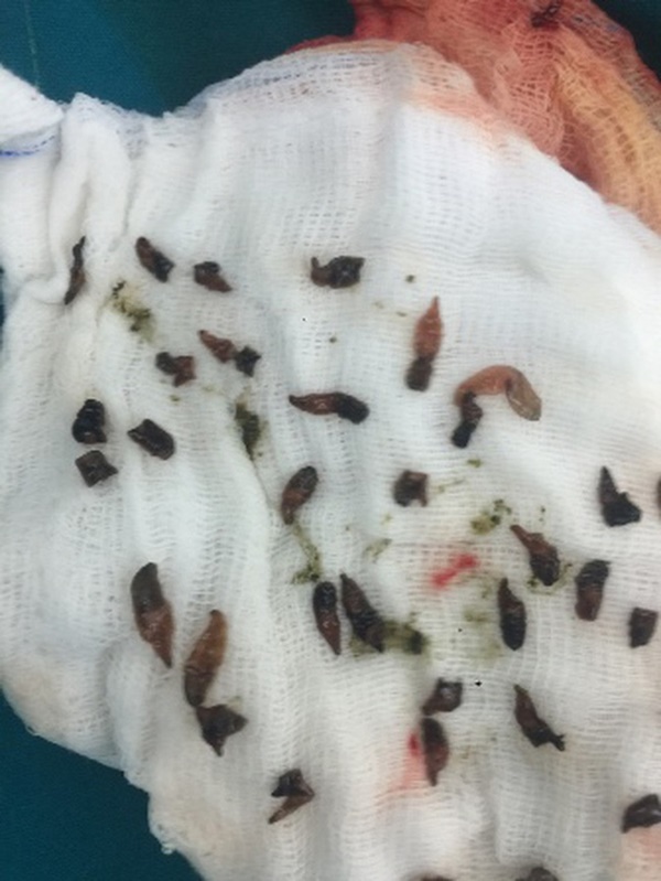 Kinh hãi hàng nghìn con sán lá gan làm tổ nhung nhúc trong đường mật người đàn ông: Chấm dứt thói quen ăn uống này ngay nếu bạn không muốn bị bệnh!-2