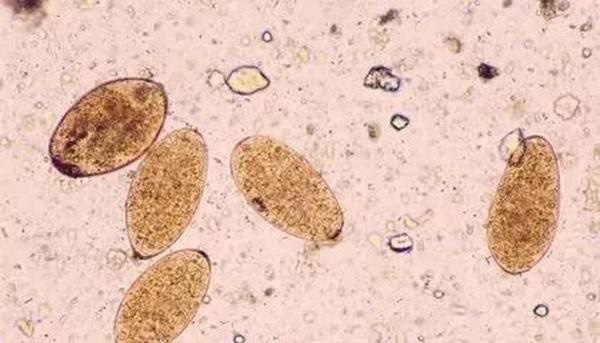 Kinh hãi hàng nghìn con sán lá gan làm tổ nhung nhúc trong đường mật người đàn ông: Chấm dứt thói quen ăn uống này ngay nếu bạn không muốn bị bệnh!-5