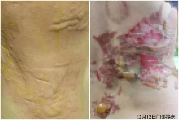 Nữ diễn viên phim Diên Hi công lược bị bỏng nặng ở lưng sau khi đi giác hơi thư giãn-2