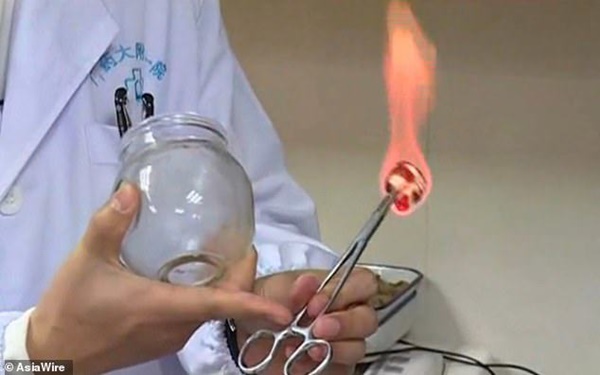 Nữ diễn viên phim Diên Hi công lược bị bỏng nặng ở lưng sau khi đi giác hơi thư giãn-4