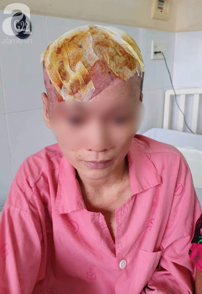 Tai nạn kinh hoàng: Tóc cuốn vào máy quấn chỉ đang khởi động, người phụ nữ bị tróc toàn bộ da đầu-1