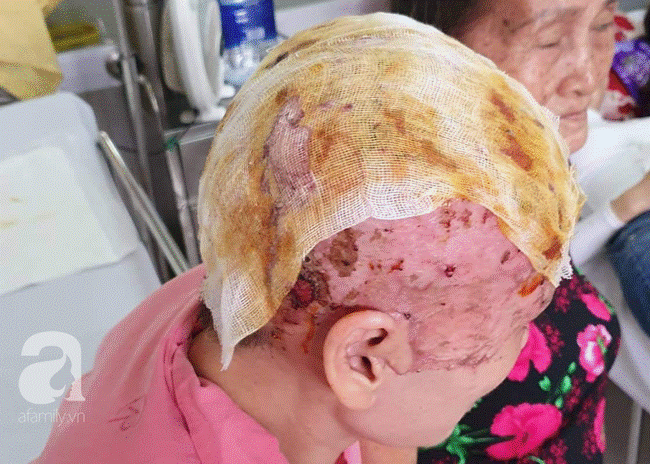Tai nạn kinh hoàng: Tóc cuốn vào máy quấn chỉ đang khởi động, người phụ nữ bị tróc toàn bộ da đầu-2