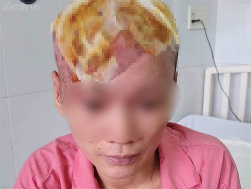 Tai nạn kinh hoàng: Tóc cuốn vào máy quấn chỉ đang khởi động, người phụ nữ bị tróc toàn bộ da đầu