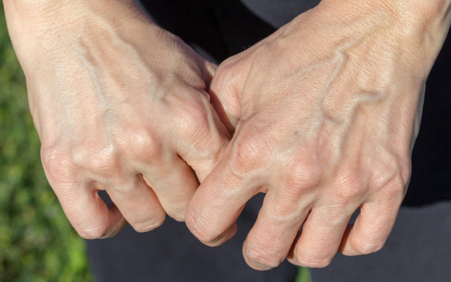 Có 3 triệu chứng này xuất hiện trên bàn tay chứng tỏ gan của bạn đang kêu cứu-4