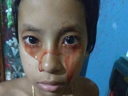 Bé gái 8 tuổi ‘khóc' ra máu