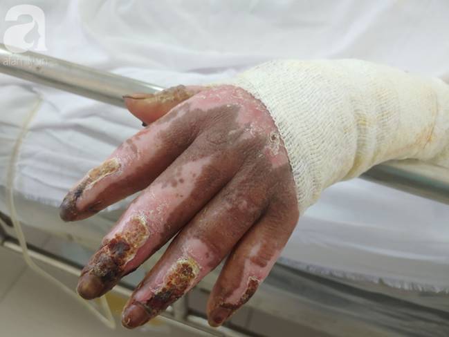 Thương tâm: Bình xăng xe phụt cháy khiến người phụ nữ nghèo bỏng nặng, con trai hiếu thảo hiến da cứu mẹ-6