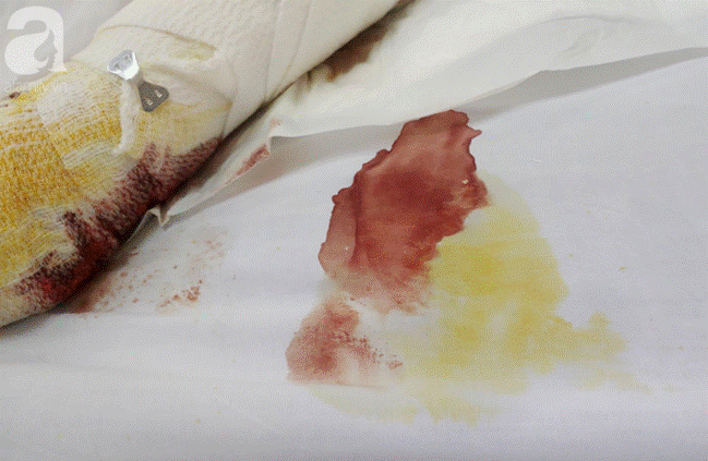 Thương tâm: Bình xăng xe phụt cháy khiến người phụ nữ nghèo bỏng nặng, con trai hiếu thảo hiến da cứu mẹ-13