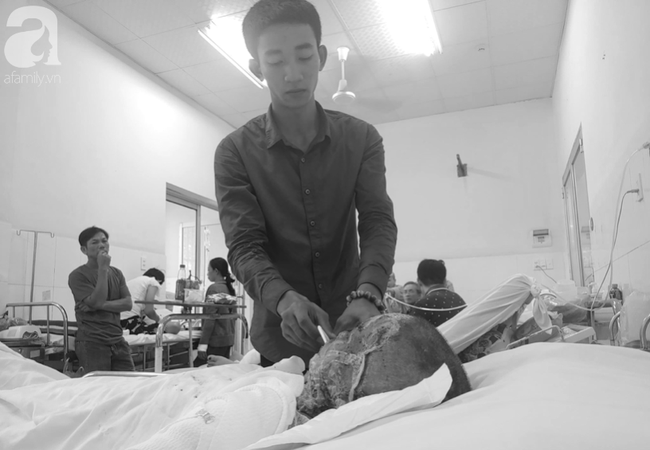 Thương tâm: Bình xăng xe phụt cháy khiến người phụ nữ nghèo bỏng nặng, con trai hiếu thảo hiến da cứu mẹ-11