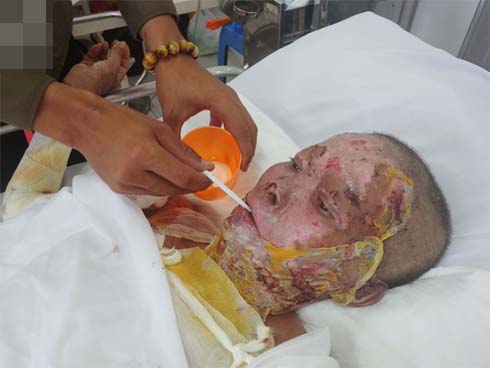 Thấy vợ ăn ốc không để phần, chồng hắt nước sôi vào mặt khiến vợ bỏng nặng-2