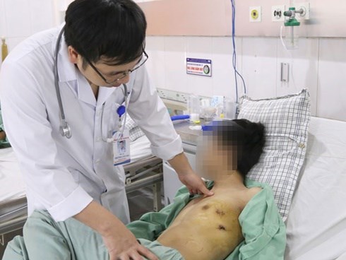 Nam thanh niên 23 tuổi xẹp phổi sau 5 năm hút thuốc