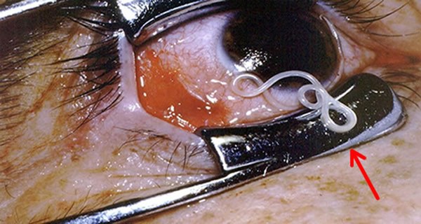 2019 - Năm của những ca bệnh kinh hoàng khi giun sán sinh sôi trong cơ thể, chọc thủng mắt, len vào tim, gan, trườn lên cả não... do thói quen ăn đồ tái sống-1