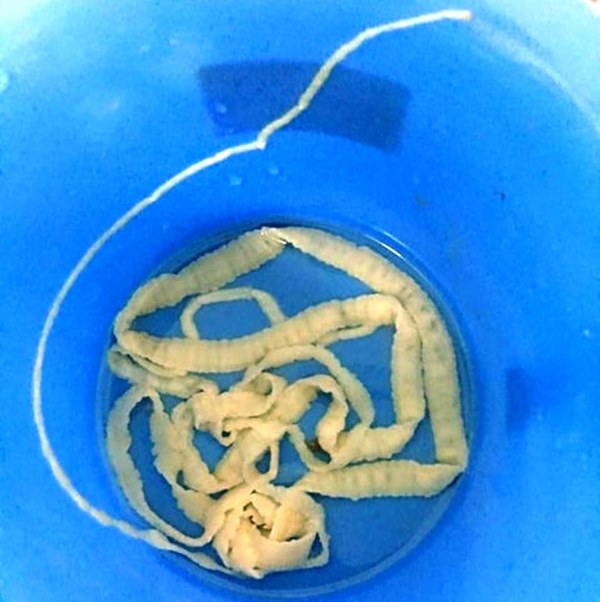 2019 - Năm của những ca bệnh kinh hoàng khi giun sán sinh sôi trong cơ thể, chọc thủng mắt, len vào tim, gan, trườn lên cả não... do thói quen ăn đồ tái sống-3