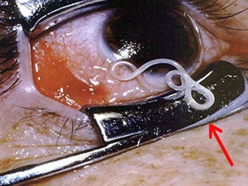 2019 - Năm của những ca bệnh kinh hoàng khi giun sán sinh sôi trong cơ thể, chọc thủng mắt, len vào tim, gan, trườn lên cả não... do thói quen ăn đồ tái sống