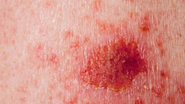 Những thay đổi trên da có thể là do các tế bào ung thư quấy nhiễu: Hãy nhanh đi khám-2