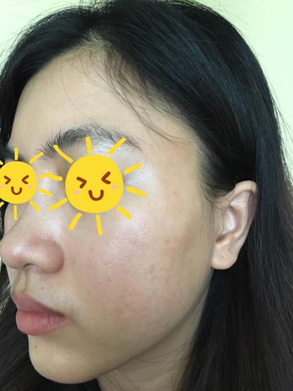 Đưa khuôn mặt nát tươm lên facebook diện kiến, cô gái trẻ ngậm ngùi cảnh báo về trào lưu nguy hại khi làm đẹp, chị em nào cũng cần cảnh giác cao độ!-4