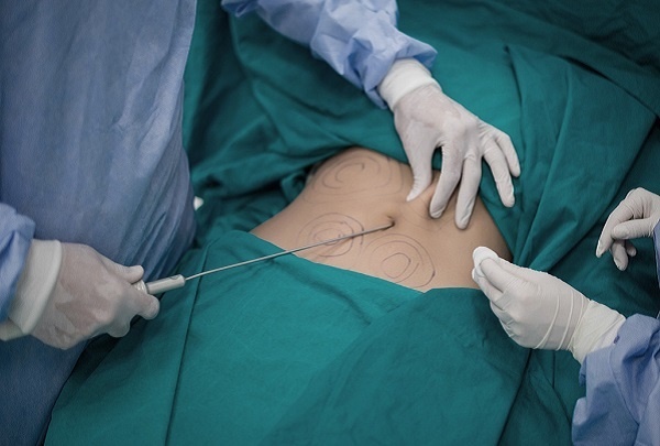 Người đàn ông tử vong khi hút mỡ bụng: Tại sao hút mỡ có thể gây chết người?-2