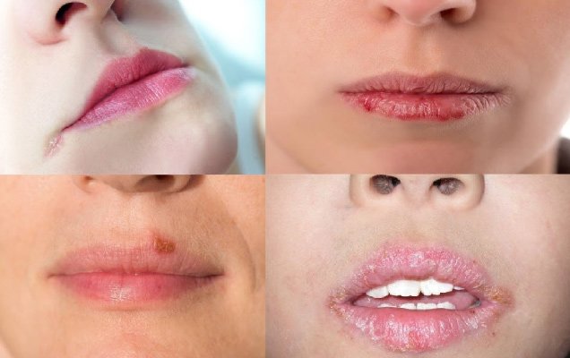 Chốc mép do đâu và cách chữa trị nhanh nhất tại nhà-1