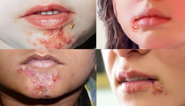 Chốc mép do đâu và cách chữa trị nhanh nhất tại nhà-2