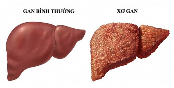 Có 4 triệu chứng khi uống rượu, bạn cần đi khám xơ gan ngay lập tức-1