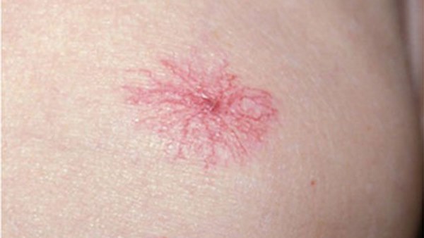 Có 4 triệu chứng khi uống rượu, bạn cần đi khám xơ gan ngay lập tức-3