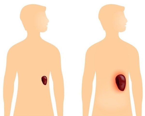 Có 4 triệu chứng khi uống rượu, bạn cần đi khám xơ gan ngay lập tức-5