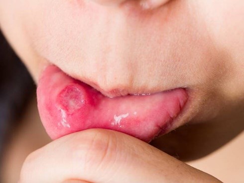 Những dấu hiệu ung thư nhưng dễ bị nhầm là 