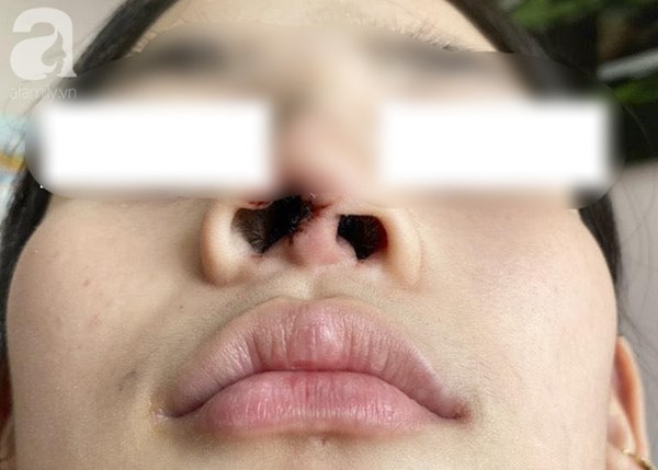 Đi nâng mũi tại spa, thiếu nữ 16 tuổi ở TP.HCM bị nhiễm trùng, biến dạng nặng nề đầu mũi-1