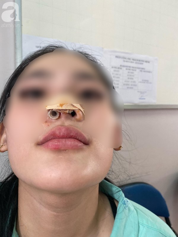 Đi nâng mũi tại spa, thiếu nữ 16 tuổi ở TP.HCM bị nhiễm trùng, biến dạng nặng nề đầu mũi-3