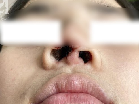 Nhẹ dạ đi tiêm filler nâng mũi tại spa trôi nổi, thiếu nữ 15 tuổi bị mù vĩnh viễn mắt trái ngày cận Tết-3