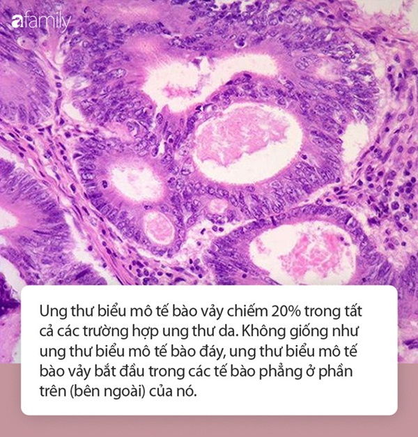 Kinh hãi chiếc sừng rồng trên lưng người đàn ông - hệ quả của ung thư biểu mô tế bào vảy-2