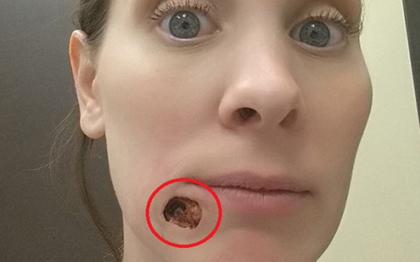 Kinh hãi chiếc sừng rồng trên lưng người đàn ông - hệ quả của ung thư biểu mô tế bào vảy-4