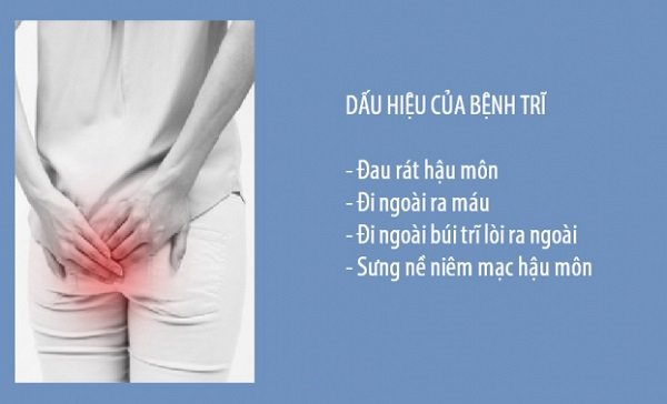 Chuyên gia chỉ rõ 3 dấu hiệu của bệnh trĩ, dấu hiệu cuối cùng nhiều người gặp nhưng chủ quan-1