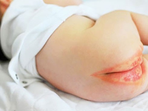 Bé 18 tháng tuổi mắc bệnh sùi mào gà vì một sai lầm của bố, nhiều gia đình có con nhỏ cũng đang mắc phải