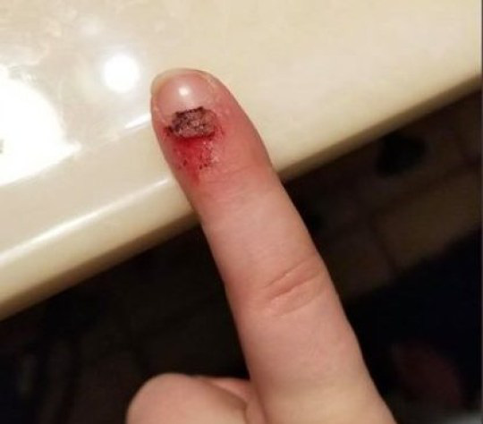 Bà mẹ lên tiếng cảnh báo sau khi phải cưa món đồ chơi trẻ em để giải cứu ngón tay cho con gái-3