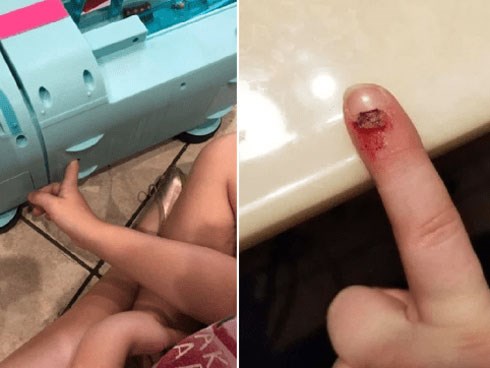 Bà mẹ lên tiếng cảnh báo sau khi phải cưa món đồ chơi trẻ em để giải cứu ngón tay cho con gái
