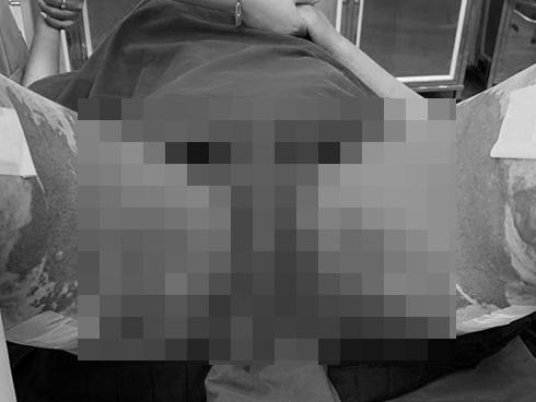 TP.HCM: Người phụ nữ suy hô hấp nặng sau khi hút mỡ bụng, nguyên nhân do hít sặc?-3