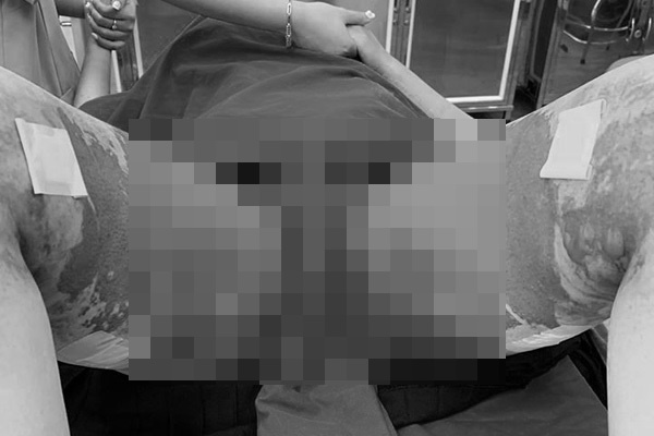 Hút mỡ tại TMV Việt Hàn, cô gái 28 tuổi bị bỏng nặng 2 chân-1