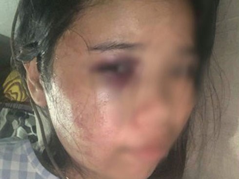 Bị chồng bạo hành đến mức nhập viện, tôi lặng người khi gặp người lạ mà quen